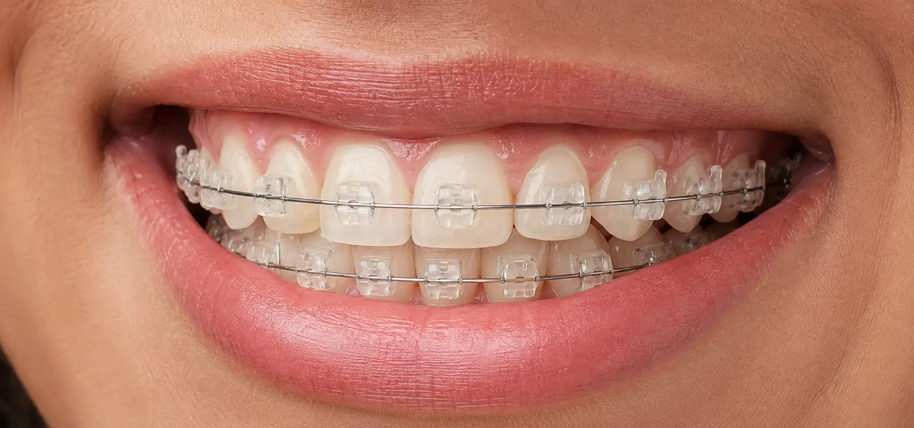 Close de um sorriso com aparelho ortodôntico estético de braquetes transparentes