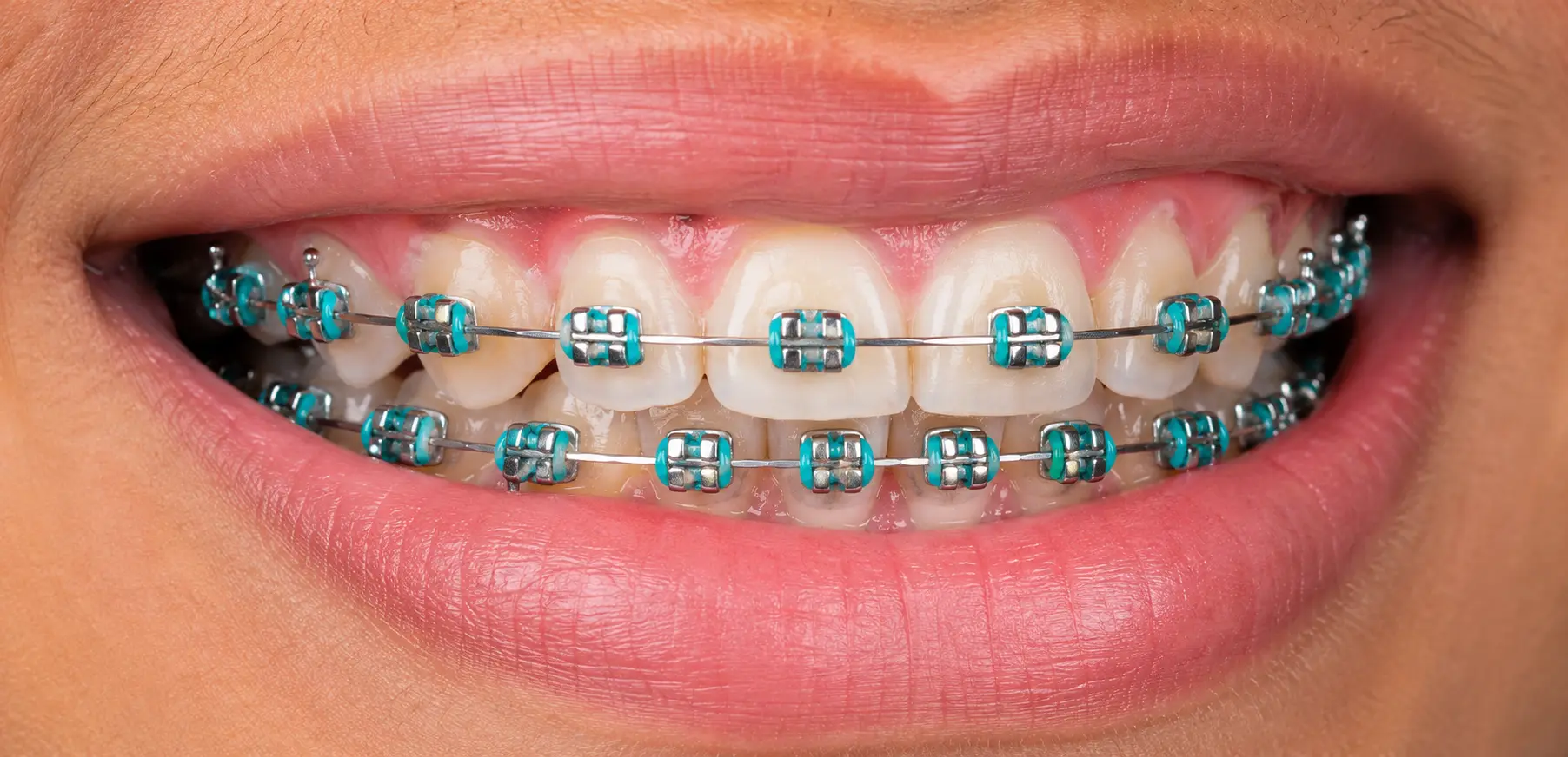 Close de um sorriso com aparelho ortodôntico fixo metálico e borrachinhas coloridas