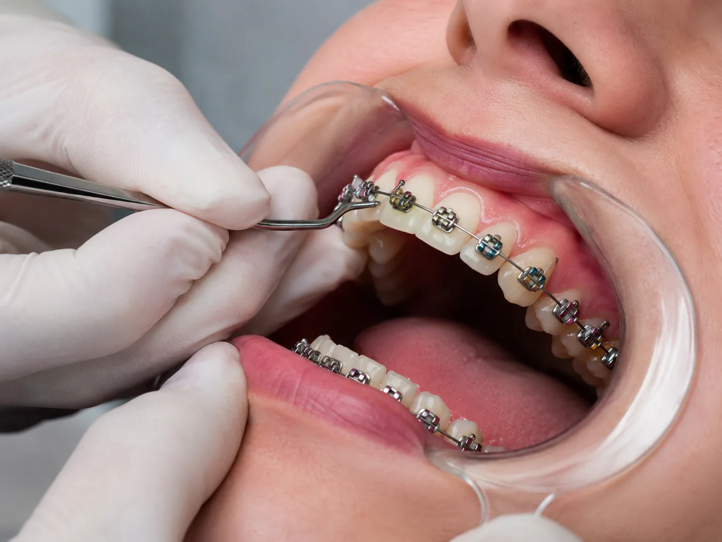 Procedimento de ortodontia sendo realizado na MySmile Dental
