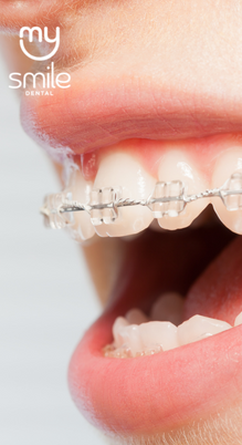 Aparelho Ortodôntico