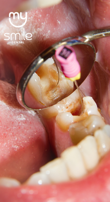 Tratamento de Canal (Endodontia)