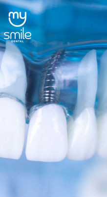 Implantes Dentário
