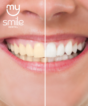 Clareamento Dental