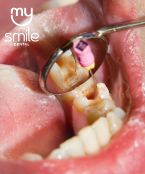 Tratamento de Canal (Endodontia)